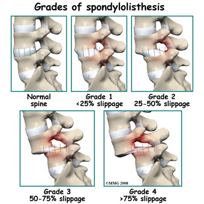 Grades of Spondylothesis